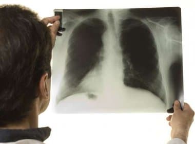 Cai a mortalidade por câncer de pulmão entre os homens, diz estudo