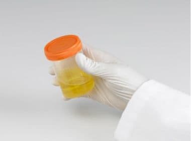 Febre amarela: cientistas detectam pela 1ª vez vírus em urina e sêmen de paciente