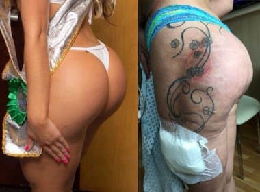 Assessor divulga fotos do bumbum de Andressa Urach antes de nova cirurgia