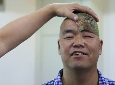 Médicos usam impressora 3D para reconstruir crânio de paciente