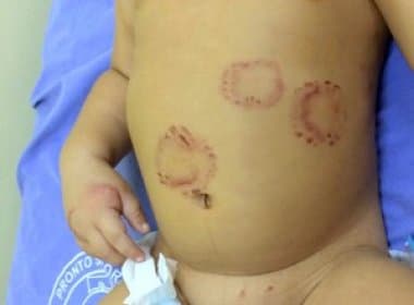 Bebê é hospitalizado com marcas de mordida no corpo e ferimentos no pênis