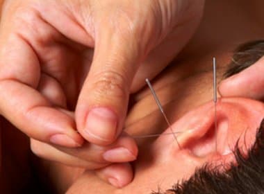 Acupuntura em cinco pontos da orelha ajuda a emagrecer, aponta pesquisa