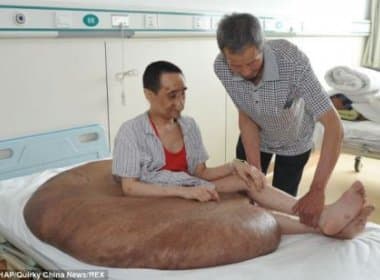 Maior tumor do mundo é removido de perna de paciente chinês; tumor pesava 110kg