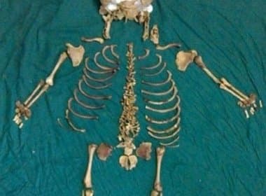 Médicos encontram esqueleto de 36 anos dentro de paciente
