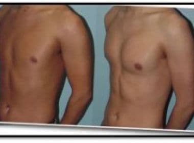 Cresce número de cirurgias plásticas de mama entre os homens 