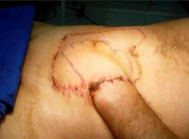 Morador de Eunápolis passa 42 dias com mão costurada à barriga devido a acidente