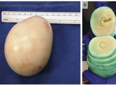 Cirurgiões retiram objeto semelhante a ovo de homem