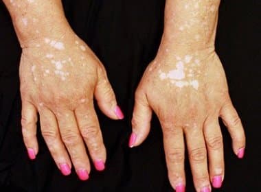 Medicamento para artrite é utilizado em tratamento de vitiligo; veja resultado
