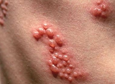 Com possíveis complicações graves, herpes zoster pode atingir quem já teve catapora
