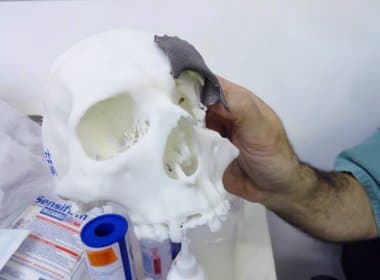 Hospital Roberto Santos realiza cirurgia inédita no Nordeste com uso de impressora 3D
