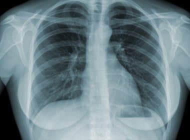 V Encontro de Pesquisa e Inovação em Tuberculose discute aspectos da doença