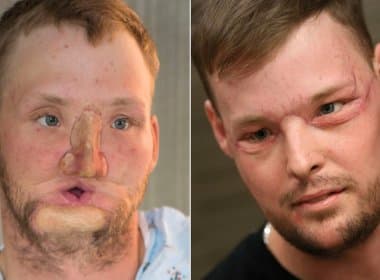 Após atirar em si mesmo, americano ganha segunda chance com transplante de rosto