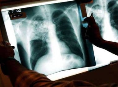 Ministério da Saúde lança Plano Nacional pelo Fim da Tuberculose