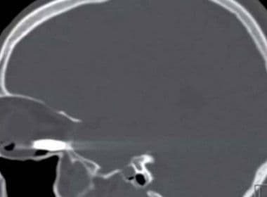 Homem sobrevive a tiro no olho direito e sai de hospital com visão intacta