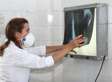 Brasil concentra 34% dos casos de coinfecção de tuberculose e HIV do mundo