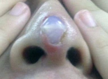 Rinoplastia dá errado e implante de silicone começa a sair de nariz de mulher