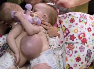 Gêmeas que dividiam mesmo coração são separadas com sucesso após cirurgia de 7 horas