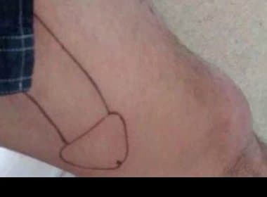 Para salvar casamento, homem remove tatuagem de pênis feita em sua coxa