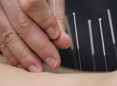 Psiclogos no podem mais usar acupuntura em tratamentos, conforme deciso do STJ