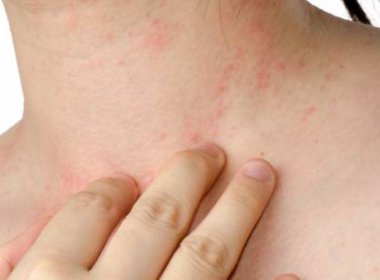 Casos suspeitos de Zika chegam a mais de 24 mil em todo o estado