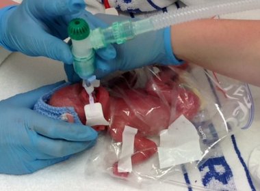 Hospital usa saco plástico para aquecer bebê prematuro 