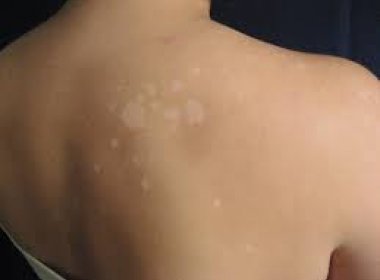 A chegada do verão também pode trazer micoses de pele