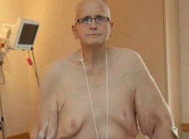Ex-mais gordo do mundo passa por cirurgia para remoção de 25 kg de pele