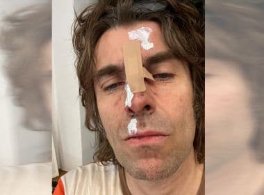 Liam Gallagher mostra rosto machucado e revela queda de helicóptero após show