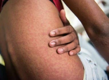 Rio registra primeiros casos de chikungunya em seu território