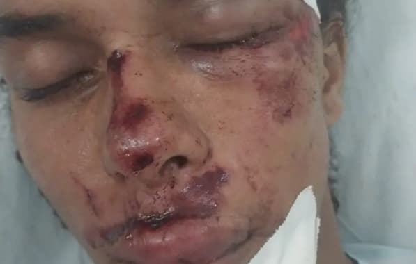 Influenciador digital fica com rosto desfigurado após assalto na Bahia