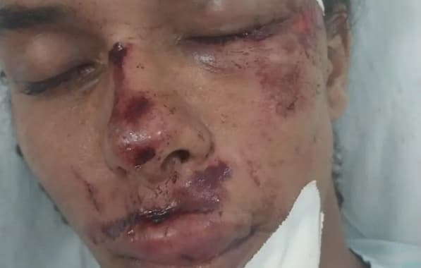 Influenciador digital recebe alta após ter rosto desfigurado em tentativa de assalto no interior baiano