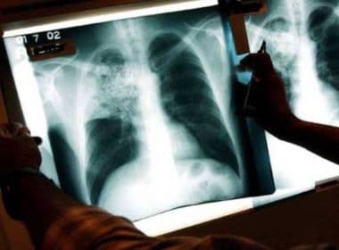 Inteligência artificial será usada para mapear risco de câncer de pulmão