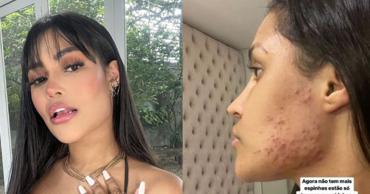 Ex-BBB Flay mostra efeito do uso de chip hormonal: 'Destruiu minha pele'