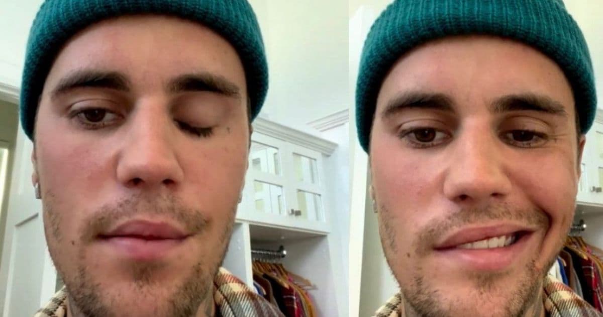 Justin Bieber tem metade do rosto paralisado por causa de síndrome rara
