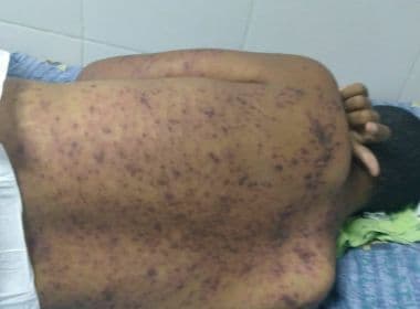 Justiça obriga Estado da Bahia a transferir jovem autista para hospital com infectologista