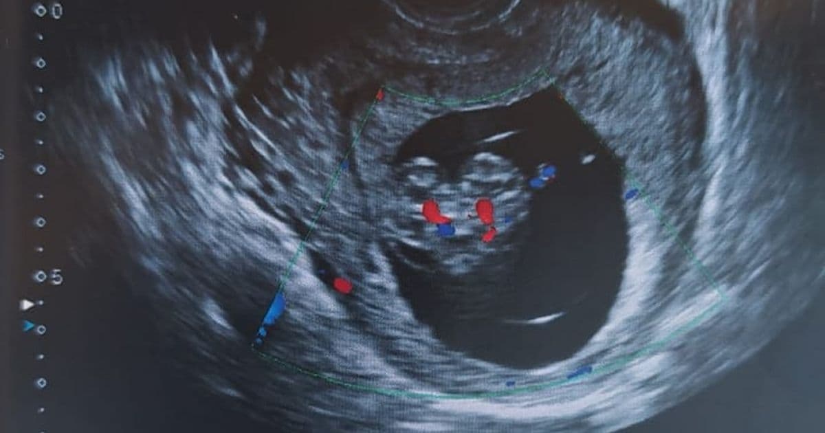 STF nega interrupção de gravidez de gêmeos siameses que não sobreviverão ao nascer