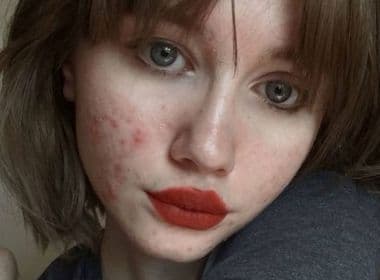  Mulher compartilha selfie para provar que 'acne não te faz ser feia'