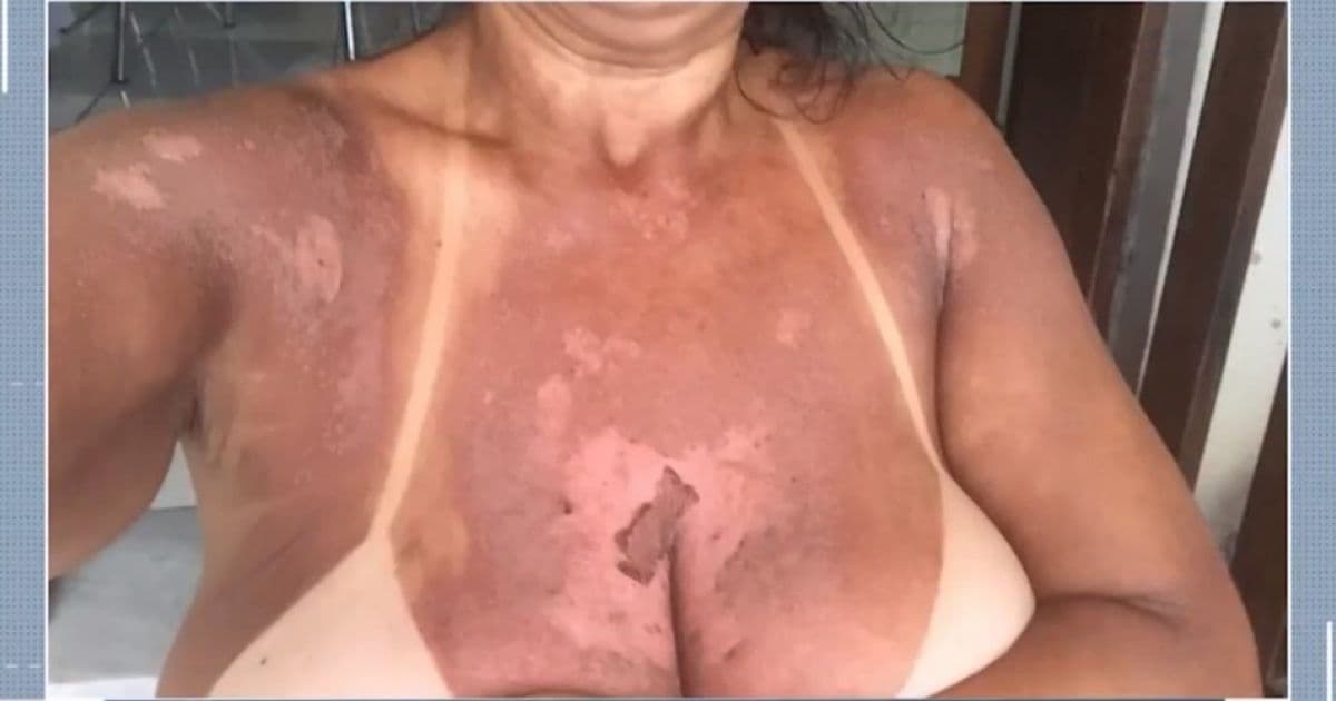 Itabuna: Mulheres denunciam clínica por queimaduras durante bronzeamento com fita