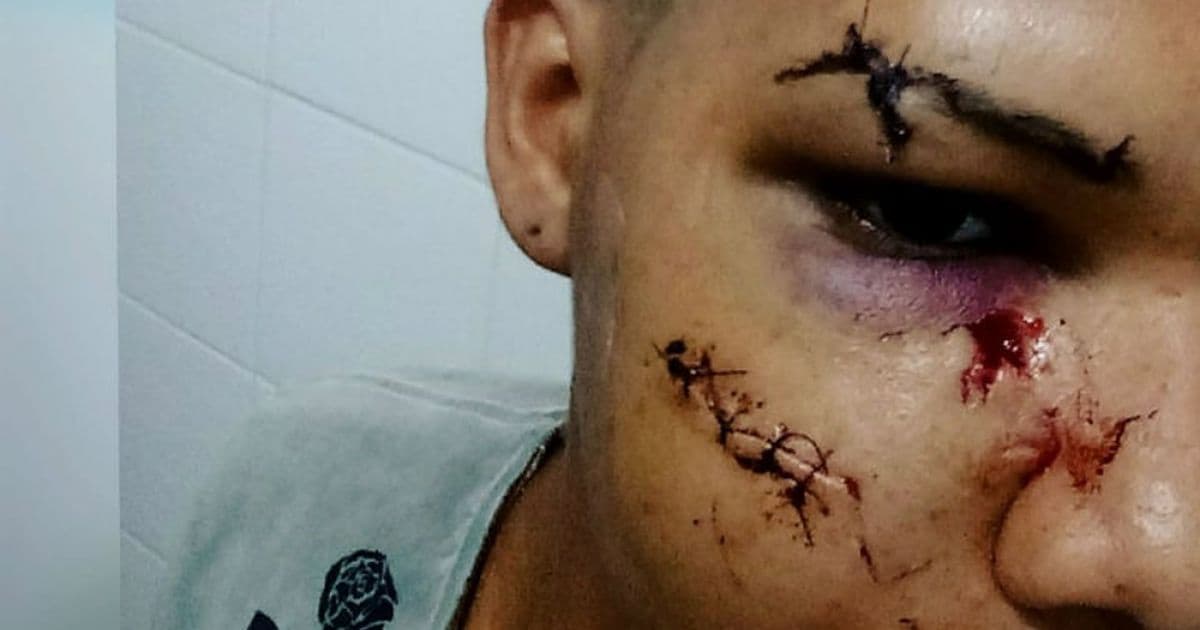 Juazeiro: Cabelereiro tem rosto desfigurado por agressão e relata crime de homofobia
