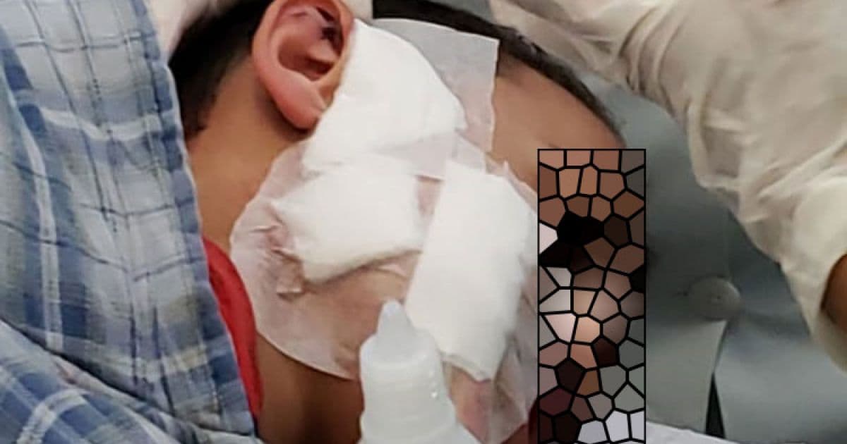 Brumado: Menino de nove anos é atacado por Pitbull e leva 15 pontos no rosto