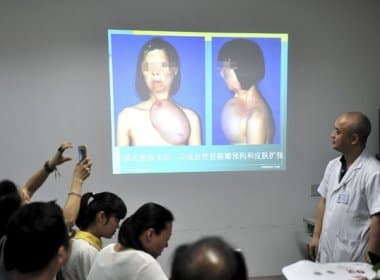Cientistas chineses criam rosto em seio de mulher e realizam transplante
