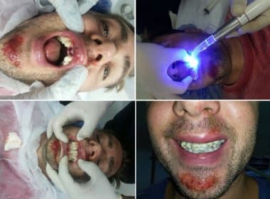 Britânico tem dente implantado após queda no carnaval