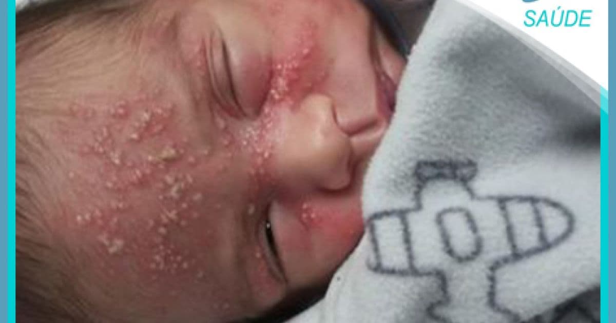 Destaque em Saúde: Após doença de filho, mãe alerta sobre risco de se beijar bebês