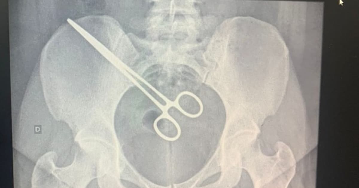 Mulher descobre pinça cirúrgica dentro do corpo ao visitar marido em presídio