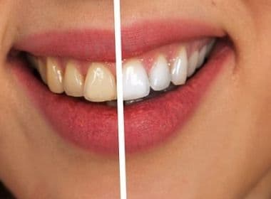 Viver Bem: Uso de Lentes de Contato nos dentes e o cuidado com a saúde bucal