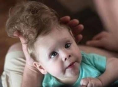 Apesar de diagnóstico pessimista, bebê sobrevive com cérebro fora do crânio