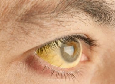 Febre Amarela pode ser transmitida sexualmente e detectada por exame de urina
