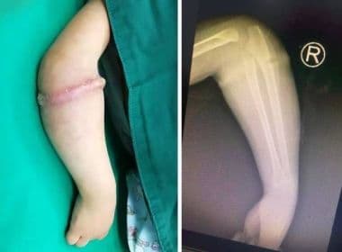 Criança passa por cirurgia para retirada de elástico de borracha do braço