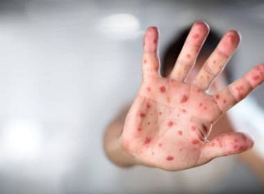 EUA confirmam 107 casos de sarampo em 2018