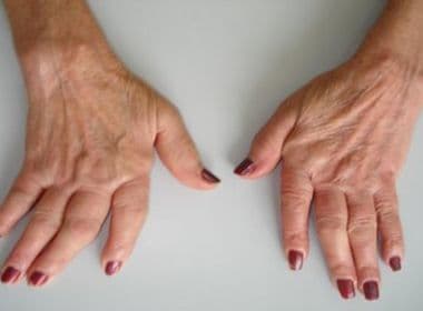 Pesquisa revela impacto de artrite reumatoide na vida social e pessoal de doentes